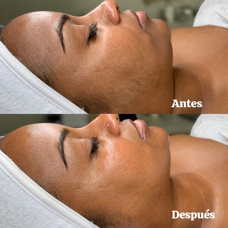 Dermaplaning + Luminoterapia