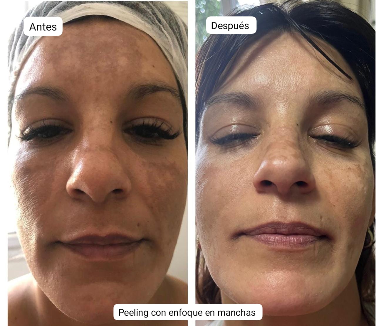 Pack Peeling Químico/Mecanico x4