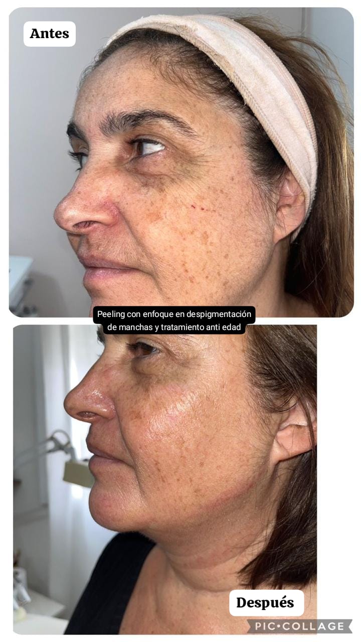 Pack Peeling Químico/Mecanico x4