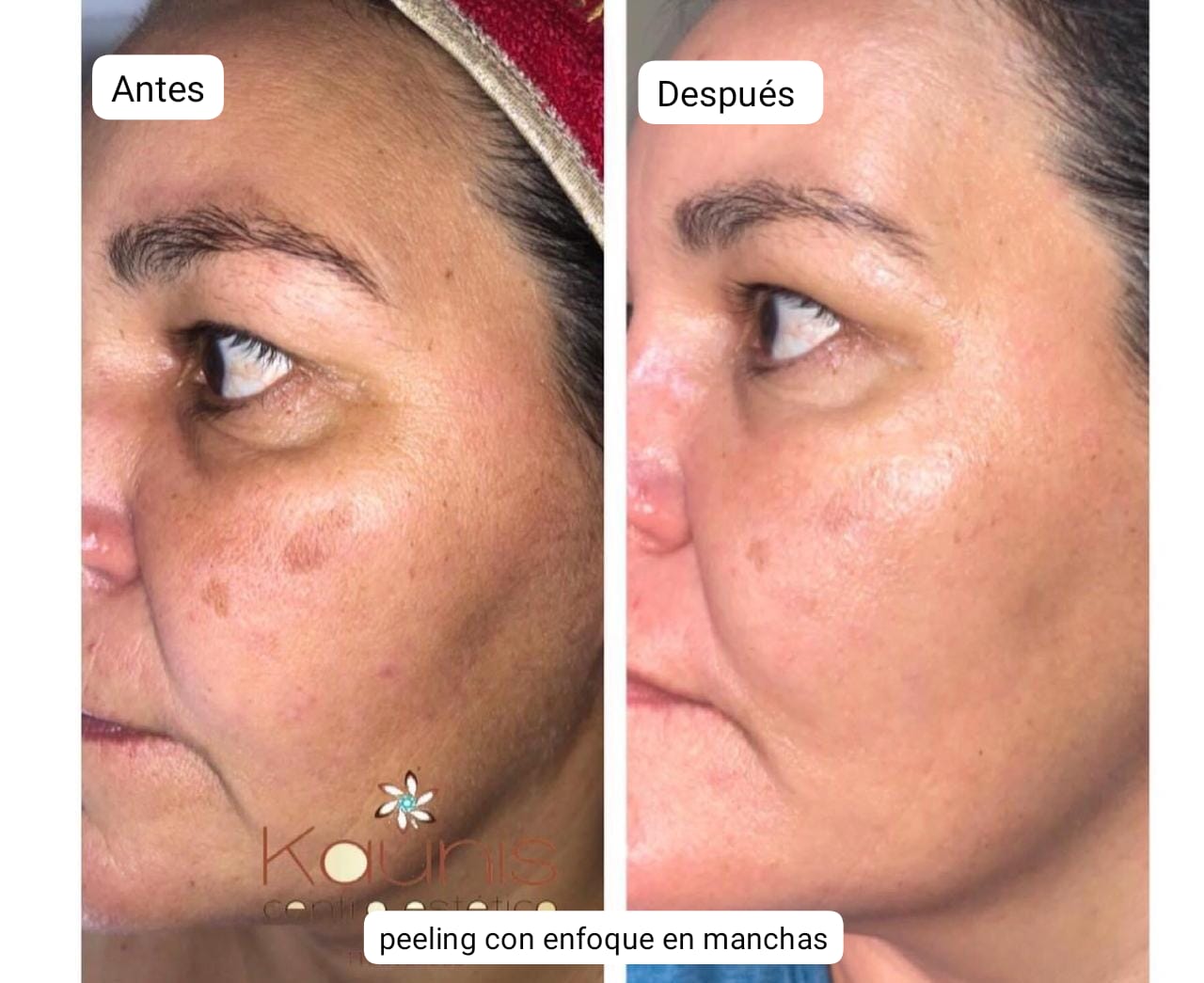 Pack Peeling Químico/Mecanico x4