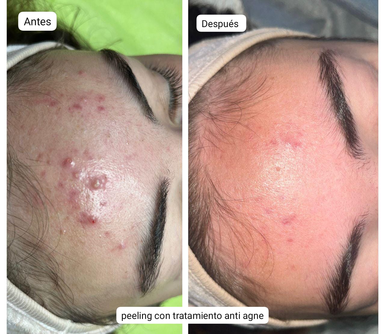 Pack Peeling Químico/Mecanico x4