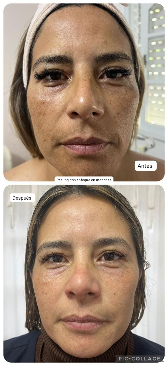 Pack Peeling Químico/Mecanico x4