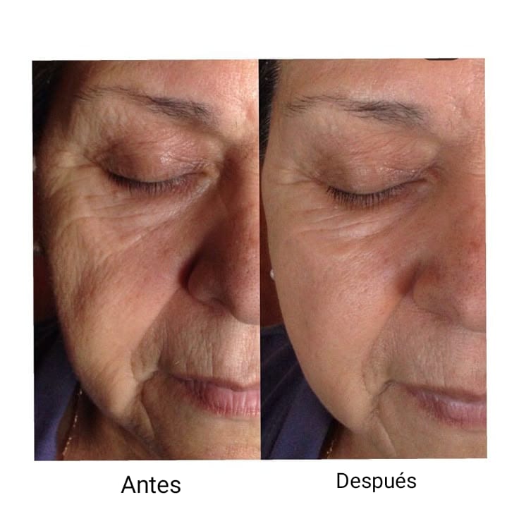 Crioradiofrecuencia Facial y Corporal