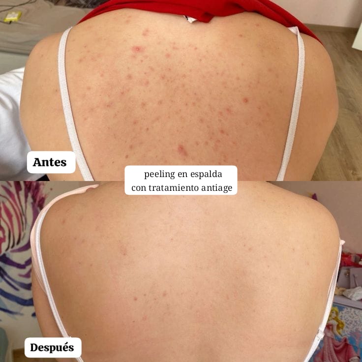 Pack Peeling Químico/Mecanico x4