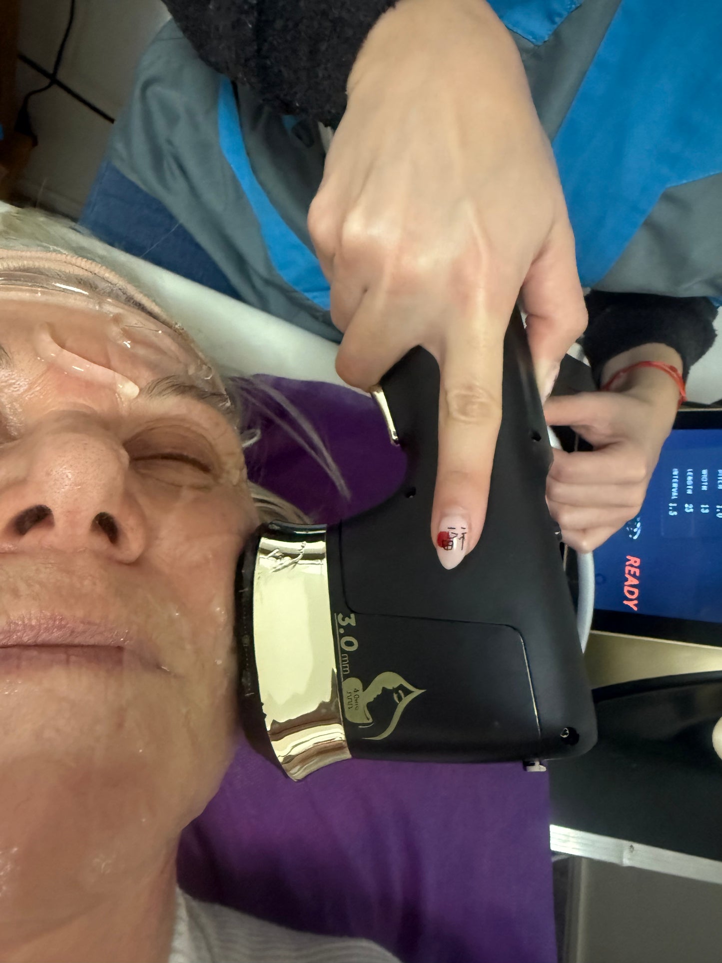 HIFU 22 D Facial