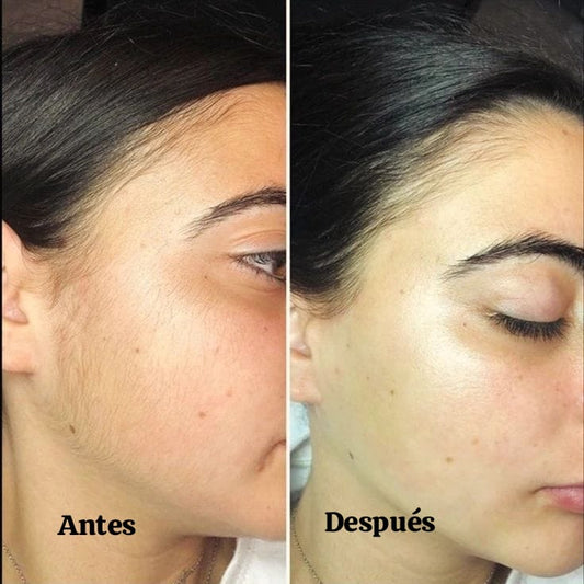 Dermaplaning + Luminoterapia