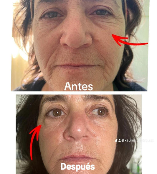Baby Botox