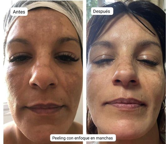 Pack Peeling Químico/Mecanico x4