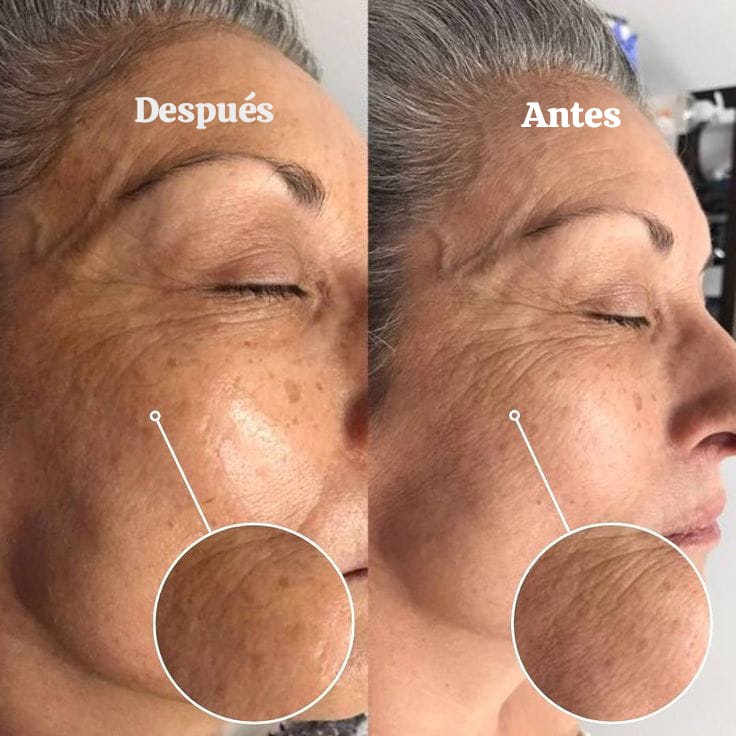 Crioradiofrecuencia Facial y Corporal