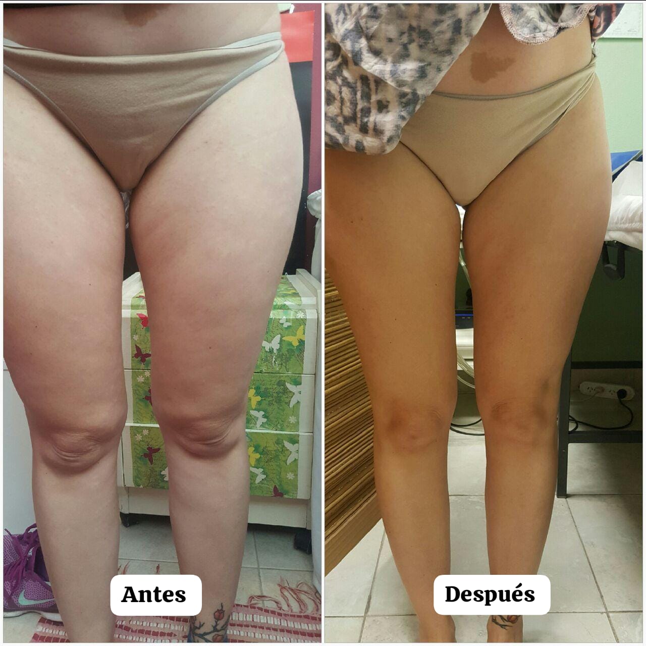Crioradiofrecuencia Facial y Corporal