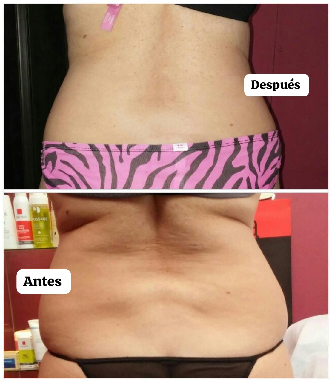 Crioradiofrecuencia Facial y Corporal